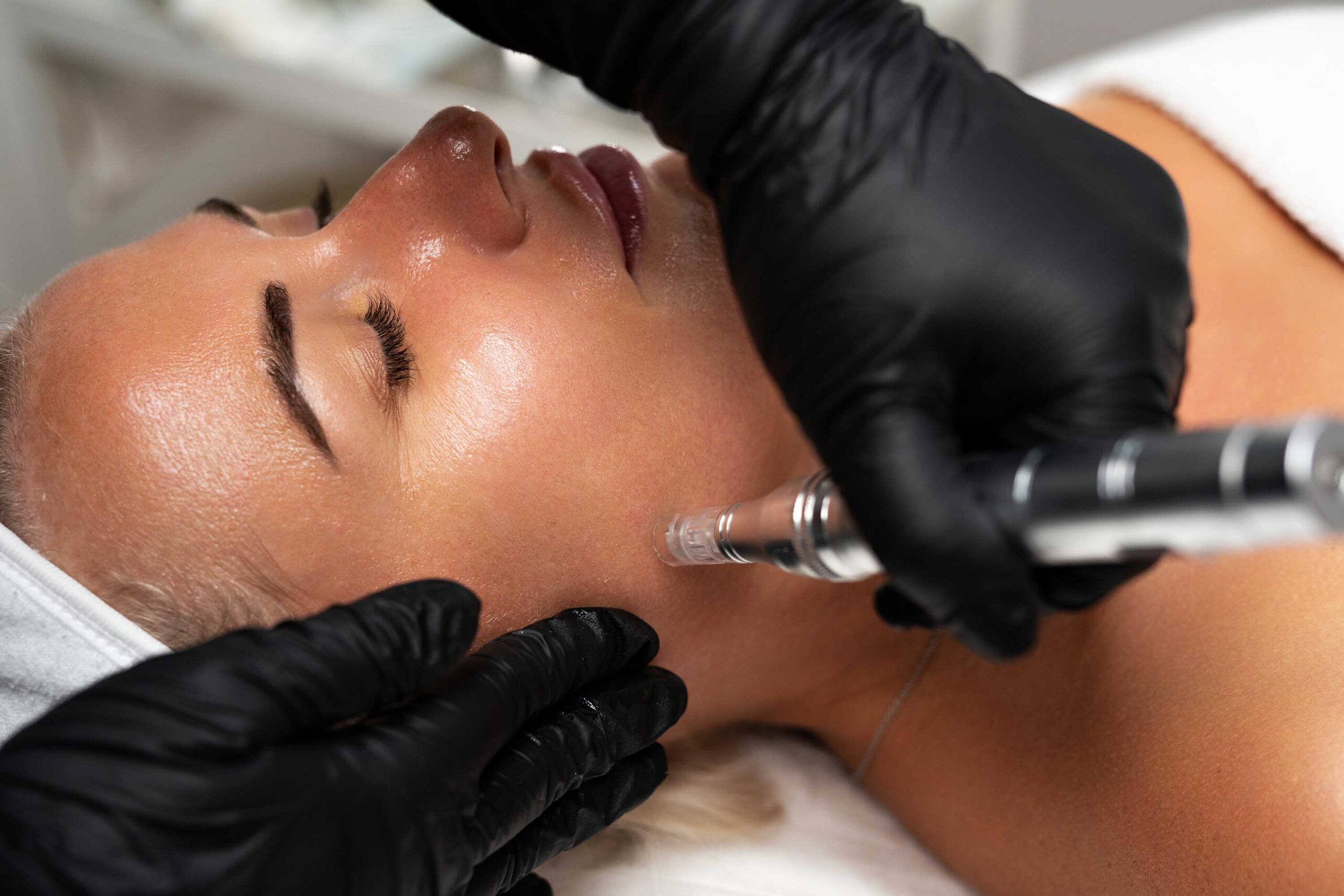 Microneedling behandling i ansiktet med dermapen hos profesjonell hudklinikk 
